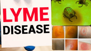 Lyme Disease: Causes, Symptoms, and Treatment